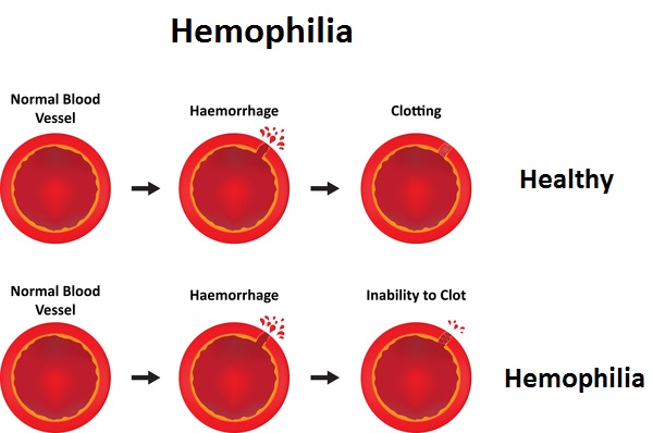 The Guyana Hemophilia Society – Guyana Times International – The Beacon ...